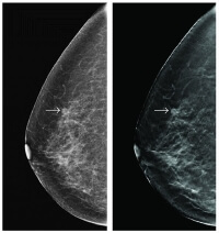 mammogram image of breast
